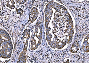 IHC staining of FFPE human adenocarcinoma of the right colon tissue with CPT1-L antibody. HIER: boil