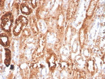 IHC staining of FFPE human renal cell carcinoma with Retinol Binding Protein 4 antibody (clone RBP4/