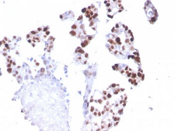 IHC staining of FFPE human breast carcinoma with POLR2A antibody (clone CTD 4H8). HIER: boil tissue 