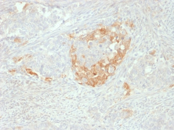 IHC staining of FFPE human neuroendocrine tumor with NSE antibody. HIER: boil tissue sections in pH 