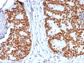 IHC staining of FFPE human colon carcinoma tissue with recombinant TP53 antibody (clone rTP53/8063).