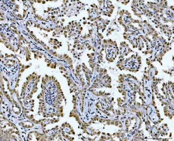 IHC staining of FFPE human lung cancer tissue with GLIS1 antibody. HIER: boil tissue sections in pH8