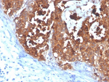 IHC staining of FFPE human colon carcinoma with CEA antibody (clone C66/4098). HIER: boil tissue sec