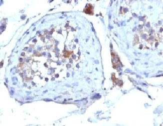 IHC: Formalin-fixed, paraffin-embedded human testicular carcinoma stained with SHBG antibody (clone 