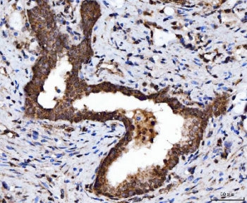 IHC staining of FFPE human prostate cancer tissue with TARBP2 antibody. HIER: boil tissue sections i
