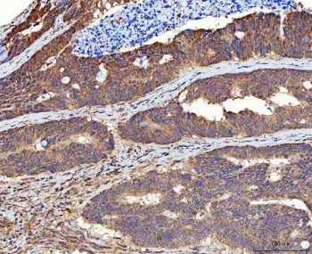 IHC staining of FFPE human colorectal adenocarcinoma tissue with MMS19 antibody. HIER: boil tissue s