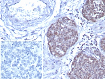 IHC staining of FFPE human ovarian cancer tissue with GATA-3 antibody (clone GATA3/7686R). Inset: PB