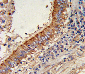 IHC testing of FFPE human lung carcinoma tissue with Major Vault Protein antibody. HIER: steam secti