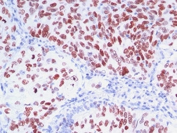 IHC: Formalin-fixed, paraffin-embedded human lung carcinoma stained with TTF-1 antibody (8G7G3/1 + N