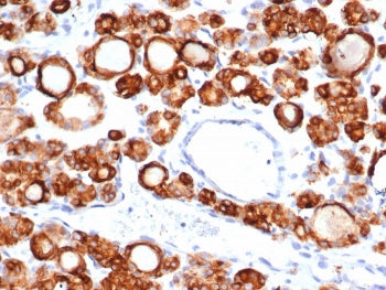 IHC staining of FFPE human thyroid carcinoma tissue with recombinant TPO antibody (clone TPO/6417R).