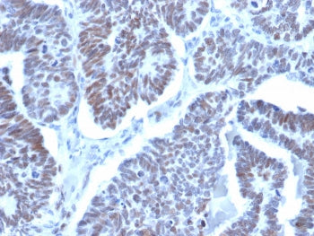IHC staining of FFPE human papillary thyroid cancer with LDB2 antibody (clone PCRP-LDB2-1B10). HIER: