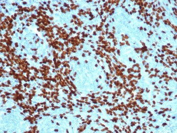 IHC staining of FFPE human thymoma with recombinant TdT antibody (clone DNTT/4617R). HIER: boil tiss