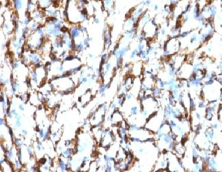 IHC testing of FFPE human angiosarcoma with Smooth Muscle Actin antibody (clone SMAT2-1). Staining o