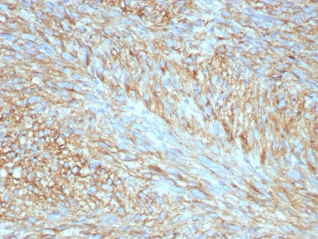 IHC staining of FFPE human GIST with c-Kit antibody (clone C117/8399R) at 2ug/ml. HIER: boil tissue 