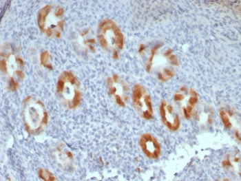 IHC staining of FFPE human cervical carcinoma tissue with Cyclin-dependent kinase inhibitor 2A antib