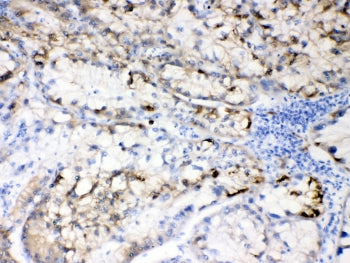 IHC testing of FFPE human liver cancer tissue with Hepatitis B Virus antibody at 0.5ug/ml. HIER: ste