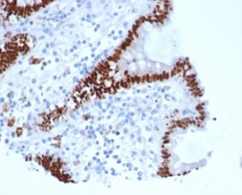 IHC staining of FFPE human colon carcinoma tissue with recombinant Caudal Type Homeobox 2 antibody (