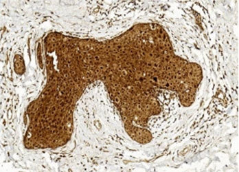 IHC testing of FFPE human breast cancer tissue with BCOR antibody. HIER: steam section in pH6 citrat