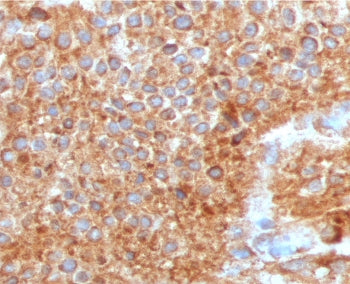 IHC staining of FFPE human urothelial carcinoma with UPK1A antibody (clone TTSP21-1). HIER: boil tis