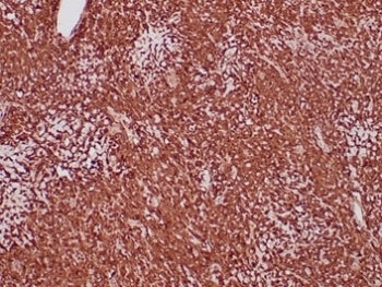 IHC staining of FFPE human sarcoma tissue with Aldehyde Dehydrogenase 1A1 antibody (clone ALDH1A1/47