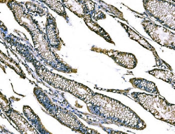 IHC staining of FFPE human gastric cancer tissue with Claudin 18 antibody. HIER: boil tissue section