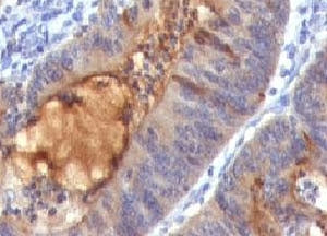 IHC: Formalin-fixed, paraffin-embedded human colon carcinoma stained with IgA Secretory Component an