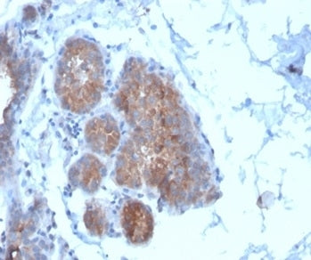 IHC staining of FFPE human breast carcinoma tissue with Migfilin-1 antibody (clone FBLIM1/4600) at 2
