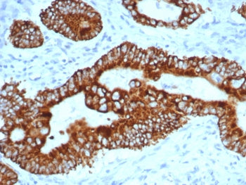 IHC staining of FFPE human colon carcinoma tissue with p504S antibody (clone AMACR/4757). HIER: boil