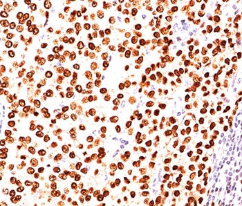 IHC testing of FFPE human breast carcinoma stained with Progesterone Receptor antibody (clone PR484)