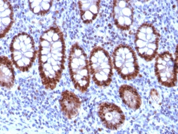 IHC staining of FFPE human colon carcinoma tissue with PU.1 antibody (clone PU1/2118). HIER: boil ti