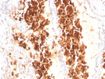 IHC staining of FFPE human angiosarcoma tissue with Glycophorin A antibody (clone rGYPA/8948). HIER: