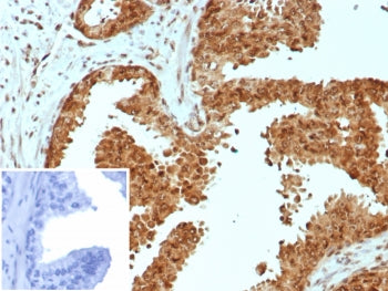 IHC staining of FFPE human prostate carcinoma tissue with CARM1 antibody (clone CARM1/7426). Inset: 