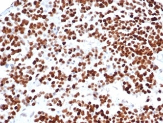 IHC staining of FFPE human serous ovarian carcinoma tissue with recombinant TP53 antibody (clone rTP