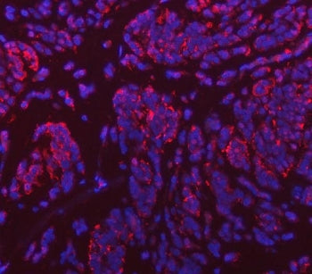 Immunofluorescent staining of FFPE human breast cancer tissue with VPS53 antibody (red) and DAPI nuc