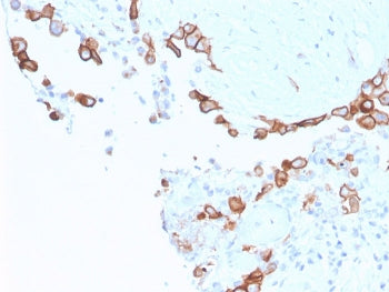 IHC staining of FFPE human mesothelioma with MSLN antibody. HIER: boil tissue sections in pH 9 10mM 