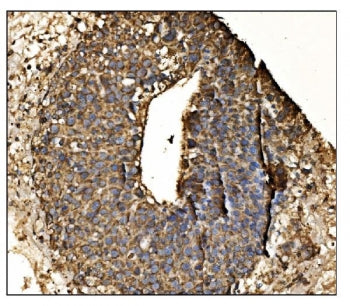 IHC staining of FFPE human liver cancer tissue with Antizyme inhibitor 2 antibody. HIER: boil tissue