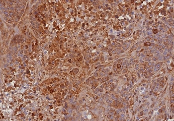 IHC staining of FFPE human bladder carcinoma tissue with TIMP2 antibody (clone TIMP2/8193R). HIER: b