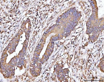 IHC staining of FFPE human colorectal adenocarcinoma tissue with MICAL-like protein 2 antibody. HIER