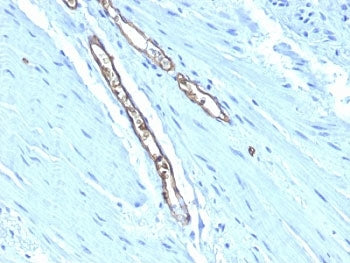 IHC: Formalin-fixed, paraffin-embedded human colon carcinoma stained with Blood Group Antigen A anti