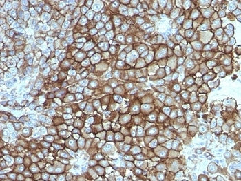IHC: Formalin-fixed, paraffin-embedded human melanoma stained with Melanoma Associated Antigen antib