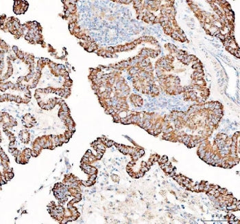 IHC staining of FFPE human thyroid cancer tissue with PPA2 antibody. HIER: boil tissue sections in p