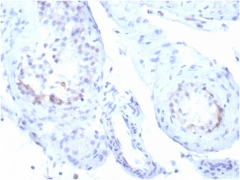 IHC staining of FFPE human testicular carcinoma tissue with recombinant StAR antibody (clone STAR/39