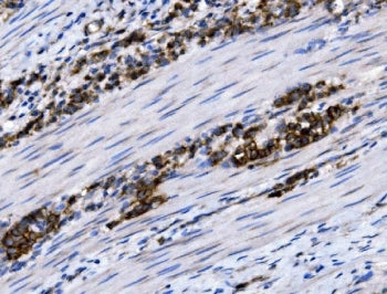 IHC staining of FFPE human rectal cancer tissue with SLC12A2 antibody. HIER: boil tissue sections in