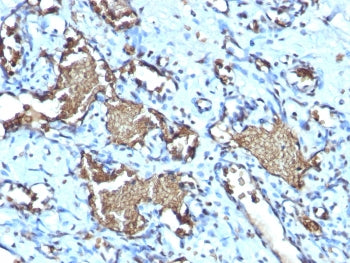 IHC testing of FFPE human angiosarcoma with recombinant Glycophorin A antibody (clone GYPA/1725R). R