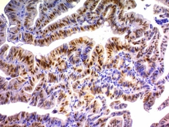 IHC analysis of formalin-fixed, paraffin-embedded human colon carcinoma stained with p21 antibody (c