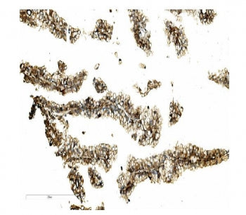 IHC staining of FFPE human renal cancer with MST-2 antibody. HIER: boil tissue sections in pH8 EDTA 