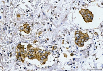 IHC staining of FFPE human breast cancer tissue with ERBB2 antibody. HIER: boil tissue sections in p