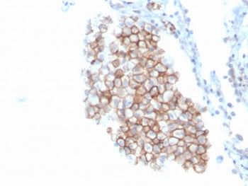IHC staining of FFPE human lung carcinoma with CD86 antibody (clone C86/3716). HIER: boil tissue sec