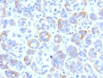 IHC testing of FFPE human melanoma with TRP1 antibody (clone TYRR1-1). Required HIER: boil tissue se