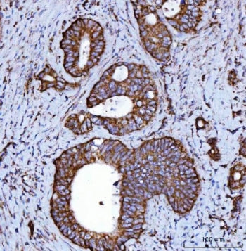 IHC staining of FFPE human colorectal adenocarcinoma tissue with NDUFS2 antibody. HIER: boil tissue 